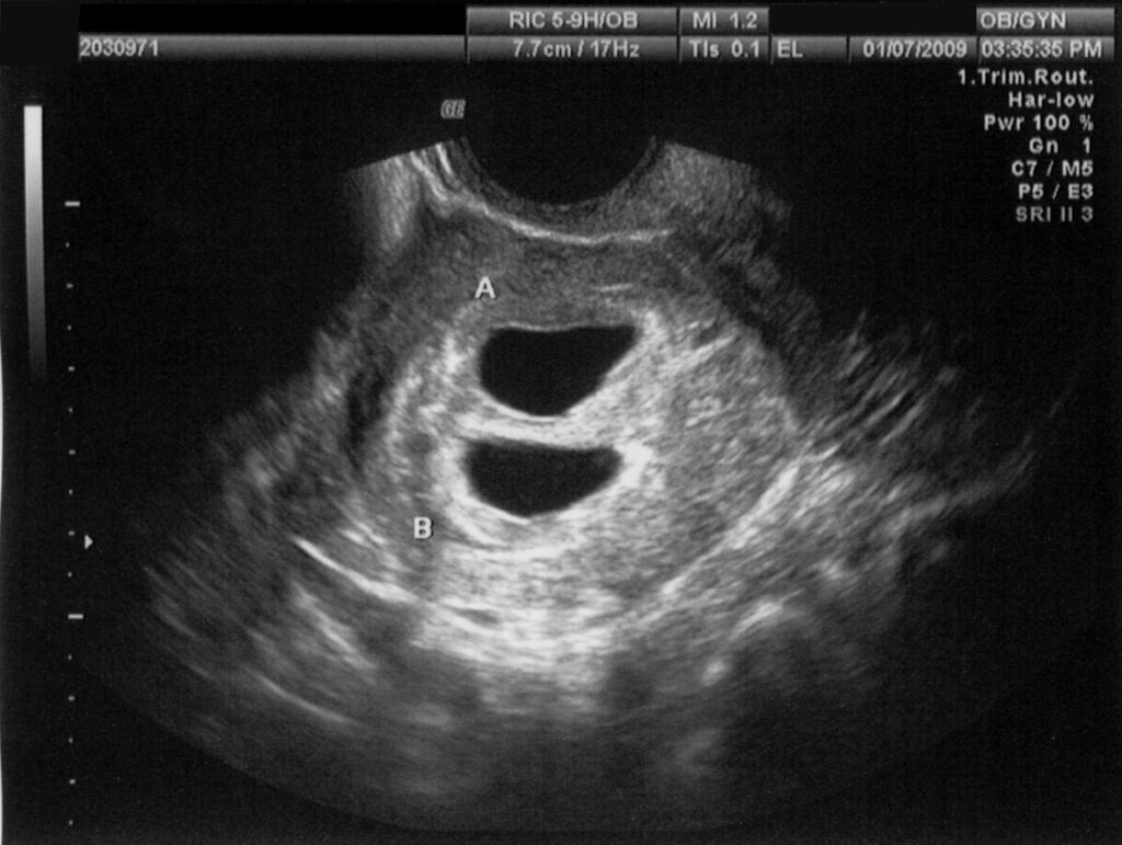 Pregnancy Tests Ultrasound